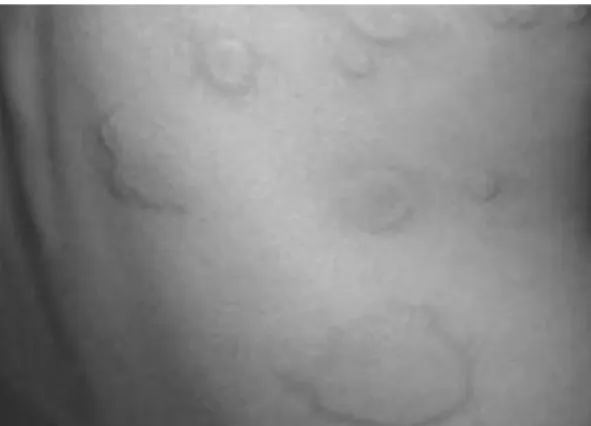 Fig. 3 Urticaria induced by drug