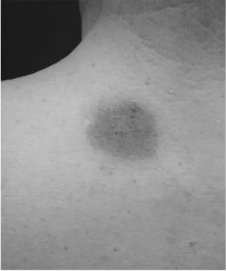 Table 5. Drugs causing acute generalized exanthematous pustulosis