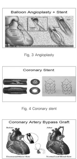Fig. 3 Angioplasty