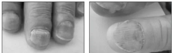 Fig. 2 - Nail Change Grade 2