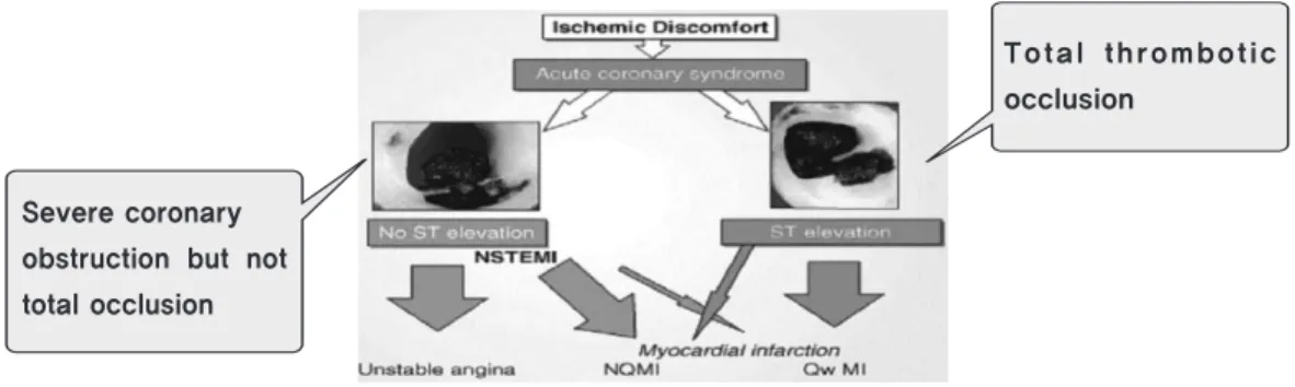 Fig. 1 - Acute Coronary Syndrome