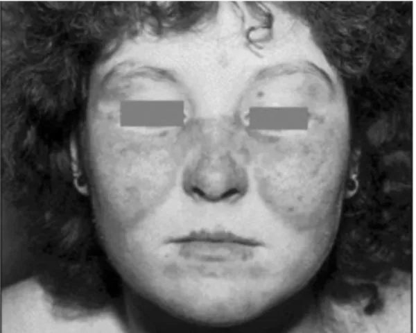 Figure 2. Butterfly Rash
