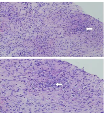 Fig. 1.  Right side wounds of the face were almost healed. Newly  developed lesions were made on her nose and left side of the cheek.