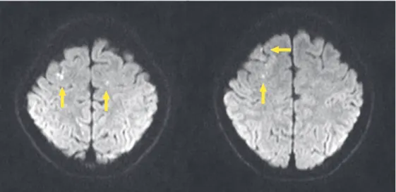 Fig. 2.  Images of the brain MRI on the day of injection. Multifocal punctated acute infarctions (yellow arrow) were found in both frontal  areas in diffusion images.