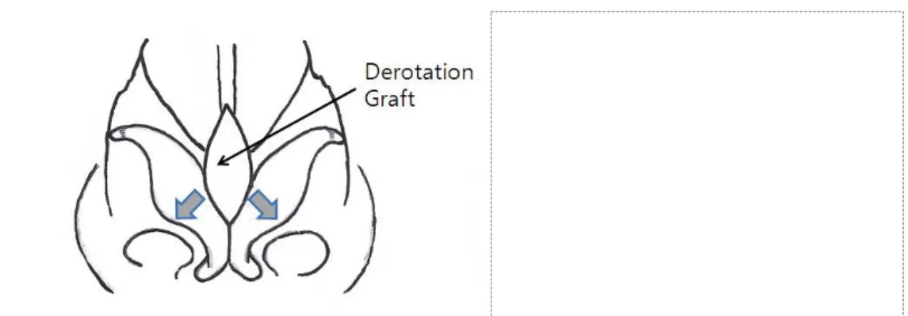 Fig. 3. Derotation Graft as an alar spreader graft. (Left) Schematic illustration. (Right) Intraoperative view.