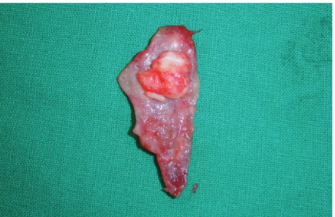 Fig. 1.  Endoscopic view of elevated mucoperichondrial flap  around septal perforation.