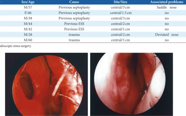 Fig. 4.  (Left) Preoperative view of septal perforation. (Right) Postoperative view showed a complete closure of the perforated septum.