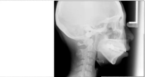 Fig. 6. Case 3. (Left) preoperative lateral view, (Right) preoperative cephalometry showing FH/AB about 70 degree which means skeletal class II although her molar occlusion was near Angle class I and normal over jet.