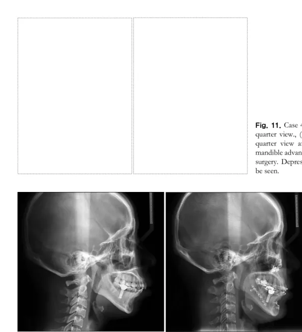 Fig. 12. Case 5. (Left) preoperative cephalometry showing FH/AB 74 degree (skeletal class II) and normal over jet, (Right) postoperative cephalometry after maxilla set back and mandible anterior segmental set back (to make over jet to allow mandible advanc