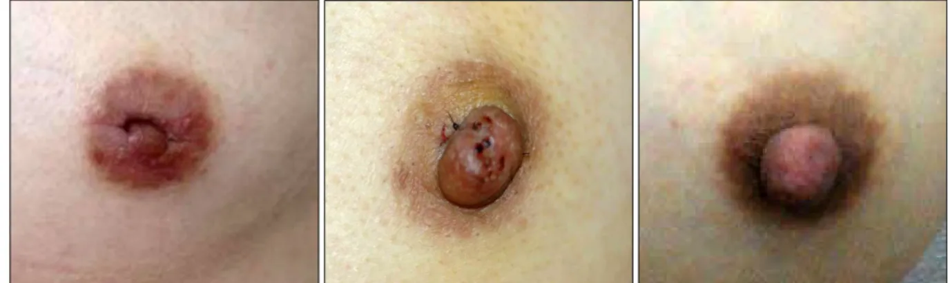 Fig. 1. (Left) Purse-string suture of upper part of nipple. (Right) Purse-string suture of lower part of nipple after suture of upper part
