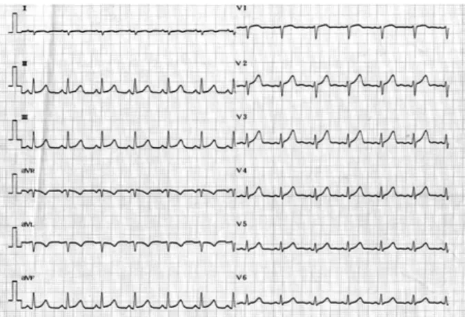 Fig. 3. ECG of 3 hours after cardioversion. There is ST segment depression and T-wave inversion on V2-V5.