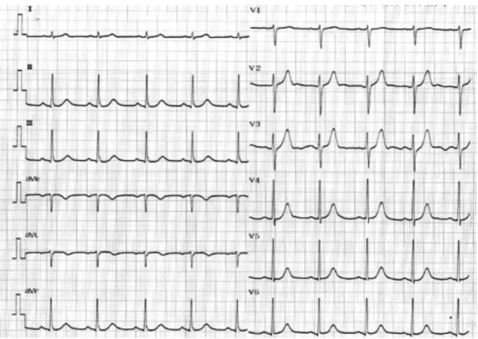 Fig. 4. Postoperative ECG after 4days. ECG shows normal sinus rhythm without any ST segment change.