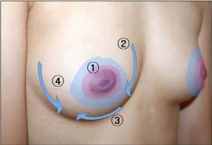 Fig. 6. After 80% of the predetermined volume was injected assess the current shape in the upright position.