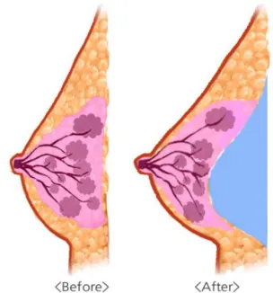 Fig. 7. During procedure, you have to keep virtual tear drop shape in mind for natural looking breast.