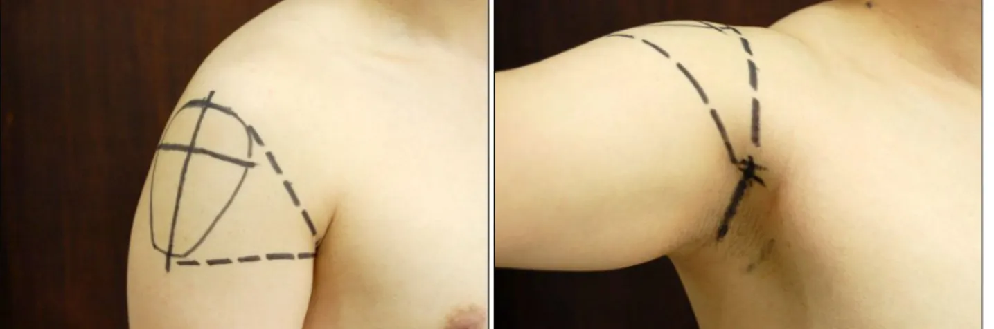 Fig. 1. Preoperative design. (Left) Adduction of the right arm. (Right) Abduction of the right arm.