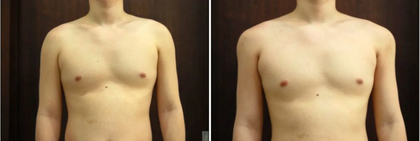 Fig. 5. Case 1 (Left) Preoperative view of a 22-year old male patient with narrow shoulder