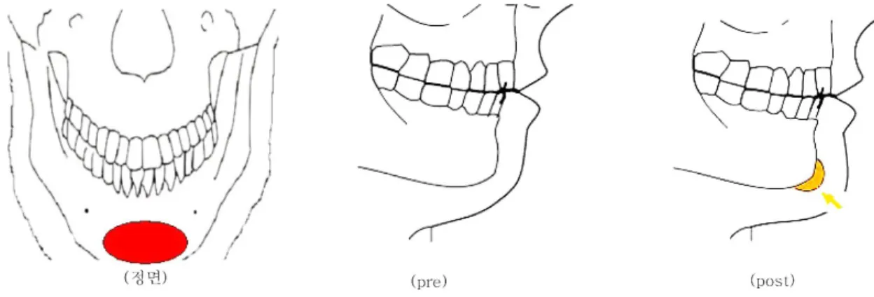 Fig. 1. Schematic diagram of supraperiosteal en-bloc filler injection. The procedure was performed by injecting the filler material inbetween the periosteum and the mentalis muscle, not over injecting past the mental foramen.