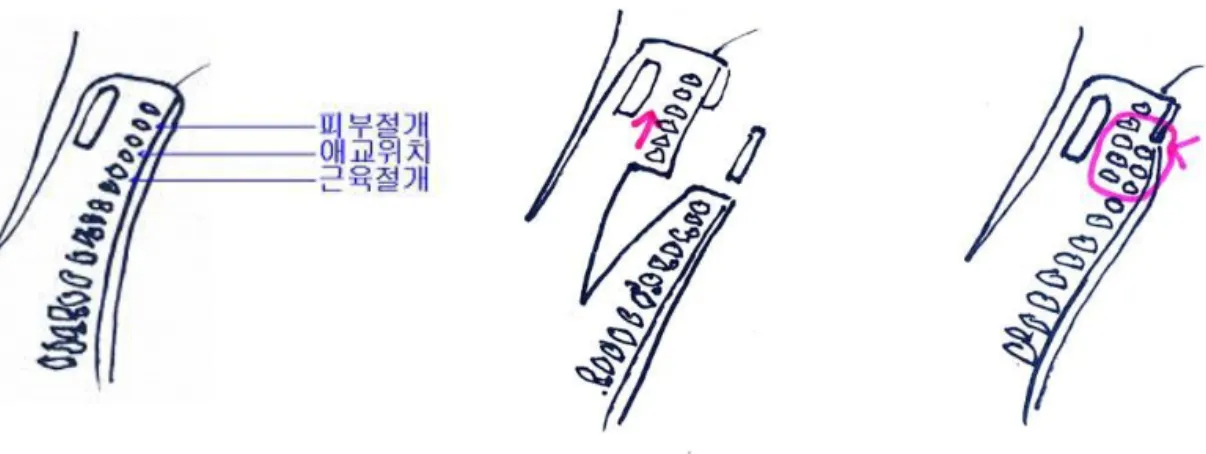 Fig. 1. Skin incision, subcutaneous dissection and suborbicularis muscle dissection.