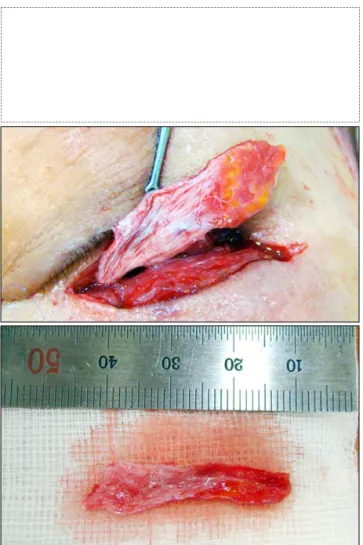 Fig. 9. Spacer graft.