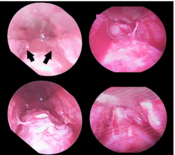 Fig. 3. Intraoperative view of the PTL (Procerus, Transverse nasali, Levator labii superior alaque nasi) muscle confluence in nasal hinge area