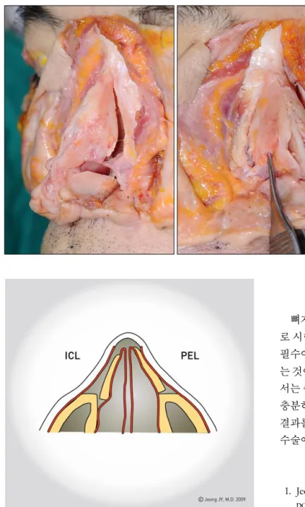 Fig. 6. Surgical demonstration using fresh cadaver. (Left) Post-intranasal  continu-ous lateral osteotomy view