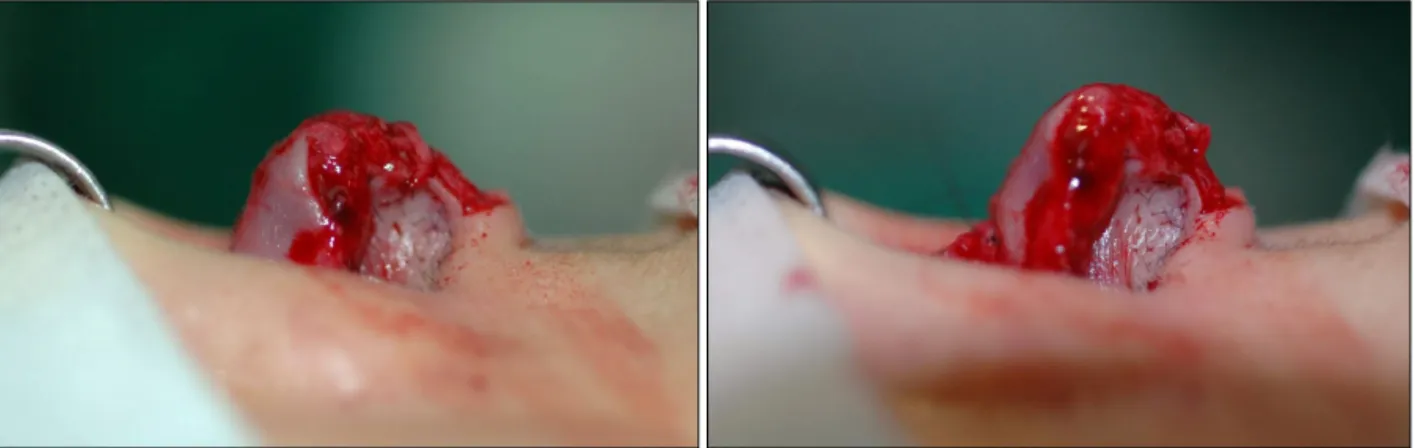 Fig. 6. (Left) Before tip extension suture and (Right) just after tip extension suture