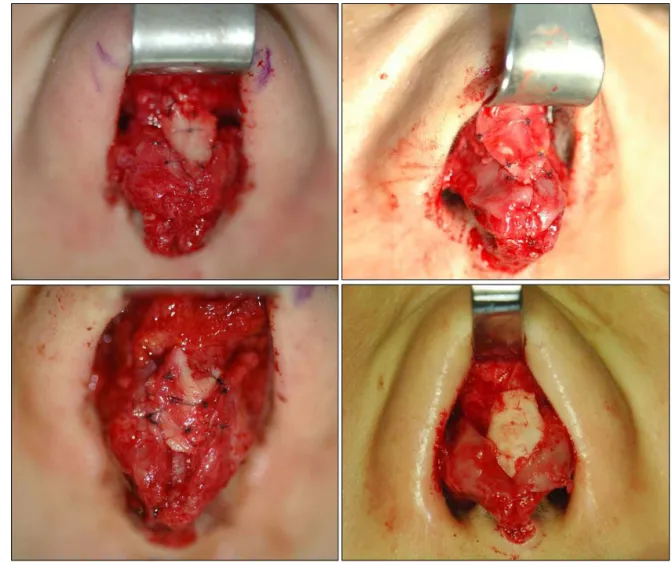Fig. 7. Photographs demonstrating various cases of derotation graft.