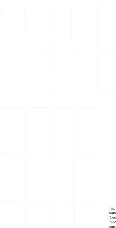 Fig. 2. (Left) Preoperative frontal and lateral views of a 23-years-old female patient