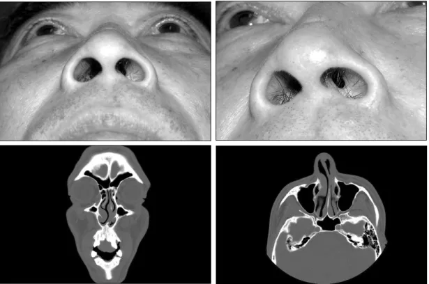 Fig. 1. (Above) Preoperative view shows a concentric narrowing of the left internal nasal valve area by mucocutaneous scar constriction on quiet inspiration