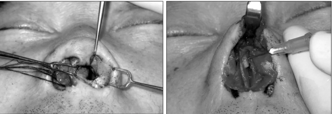 Fig. 2. Intraoperative view. (Left) Design a five-flap Z-plasty based on the nostril floor for scar release