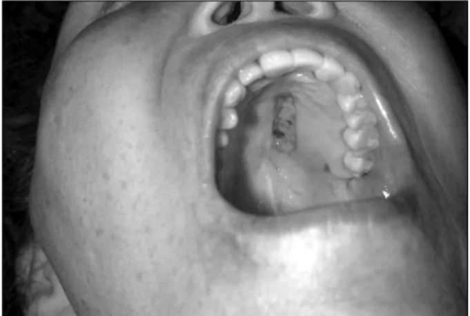 Fig. 3. Donor site of hard-palate mucosal graft. 5 × 25 mm in size.
