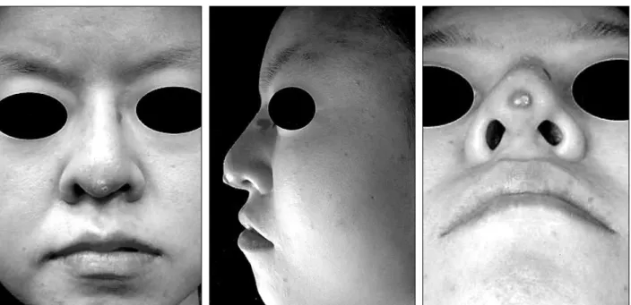 Fig. 1. A 32-year-old woman after augmentation rhinoplasty using silicone implant. The infection followed by extrusion occurred at the nasal tip and root, manifested as focal erythema and tenderness