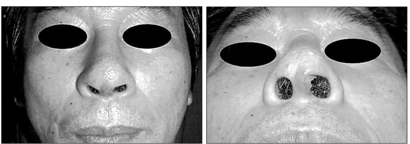 Fig. 3. A 62-year-old man after augmentation rhinoplasty using silicone implant. The infection following extrusion occurred at the incision site, or left columella, manifested as focal erythema and tenderness