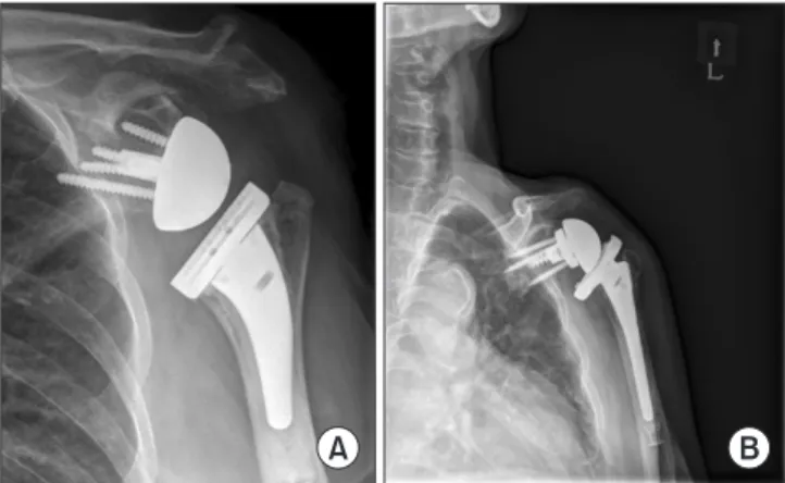Figure 1. Examples of humeral side lateralization (A) and glenoid side  lateralization (B)