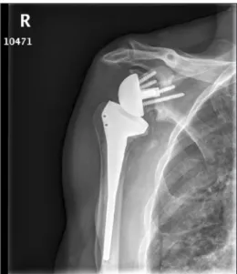 Figure 2. Radiographic finding of a scapular notching (grade I). 