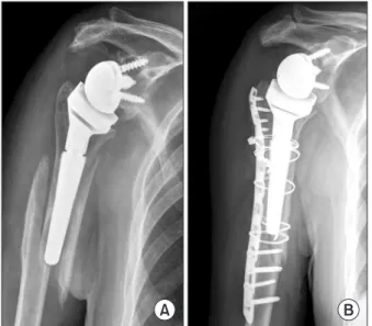 Figure 3. An 86-year-old patient with a periprosthetic fracture around  the distal part of the stem (A), eventually requiring an open reduction  and internal fixation procedure (B)