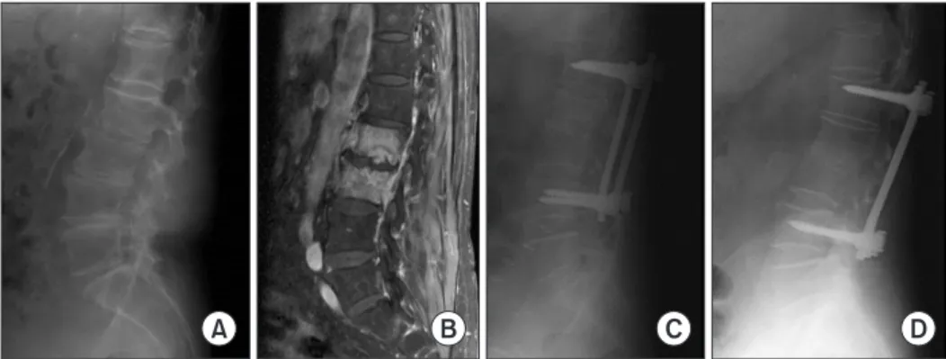 Figure 1. A 78-year-old female with pyogenic spondylodiscitis, L2-3. (A) Initial lumbosacral lateral radiograph in the standing position