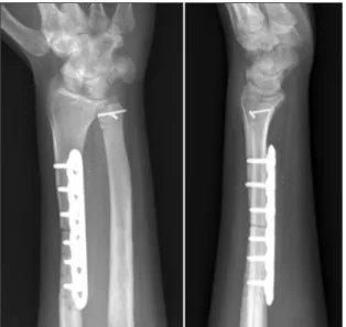 Figure 6. Computed tomography at postoperative 18 months (A, B) and  radiographs after implant removal (C) show that the ulnar head was  reduced in the radioulnar joint, and the osteotomy site of the ulnar head  was united