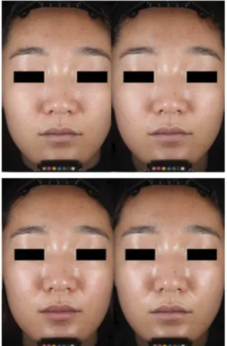 Figure 1 shows representative facial images obtained  using the parallel-polarization mode of VISIA-CR at four  times for 6 h