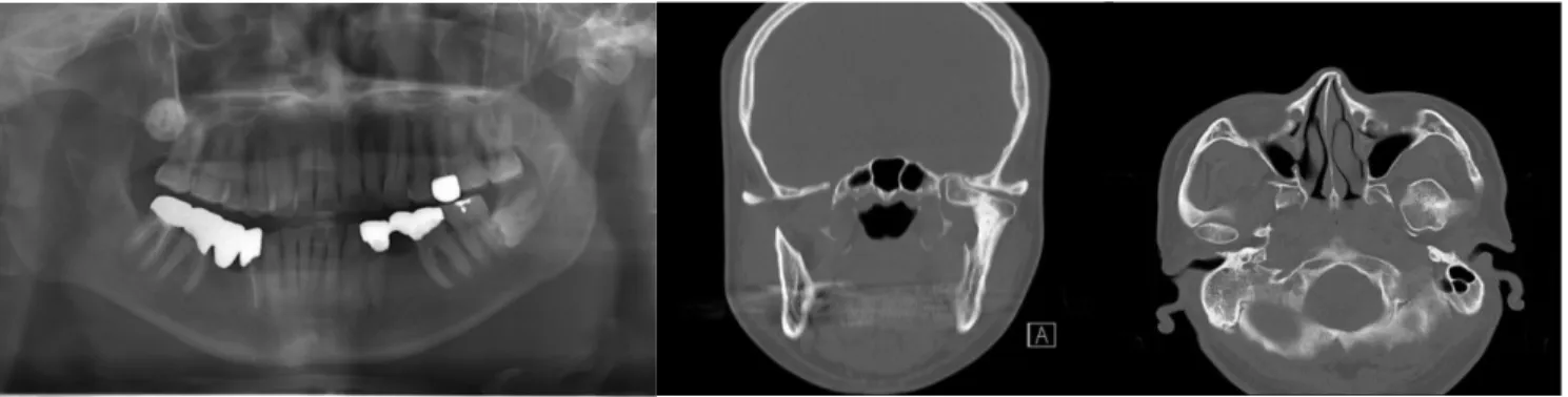Figure  2  Preoperative  panoramic  and  coronal,  axial  computed  tomography(CT)  cross-section  view