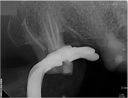 Fig.  4    Four  canals  were  obturated  using  the  continuous  wave  technique  with  GP  cones  and  sealer.