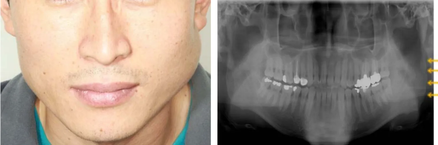 Fig.  1.  Preoperative  facial  view Fig.  2. Preoperative  panoramic  view.
