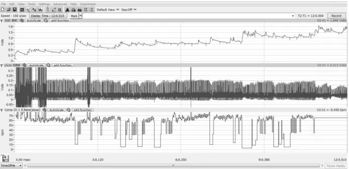Fig.  5.  G.S.R  physiologic  data  recoding  without  mouth  guard  wearing