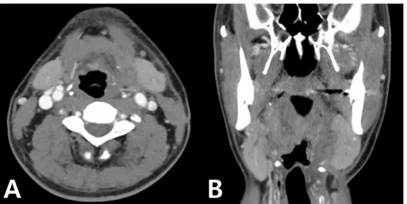 Fig.  7.  Three-month  follow-ups  enhanced  computed  tomography  showing  mass  disappeared  after  surgery  and  no  recurrence