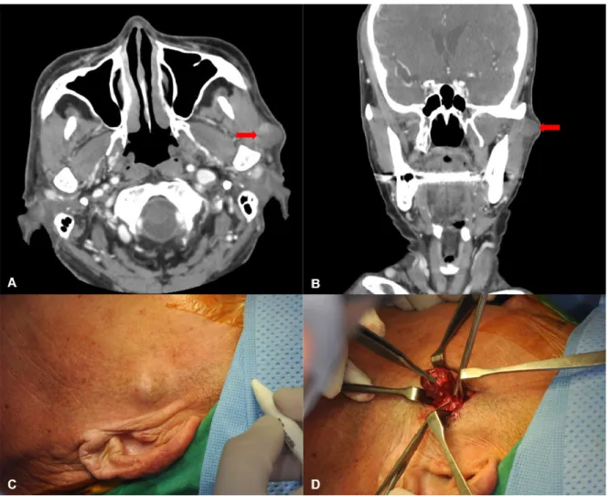 Fig.  1.  A  and  B.  The  axial  and  coronal  views  of  the  enhanced  computed  tomography  scan