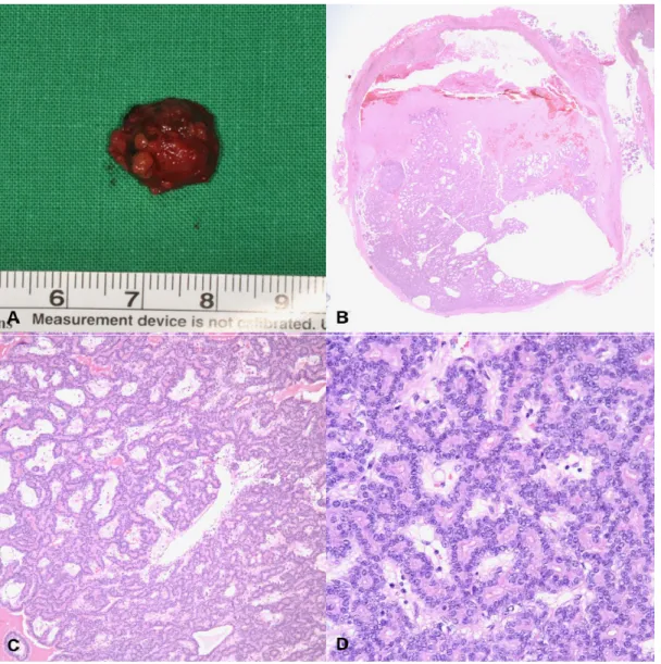 Fig.  2.  A.  An  image  of  the  removed  specimen,  which  was  about  1.5  cm  in  diameter