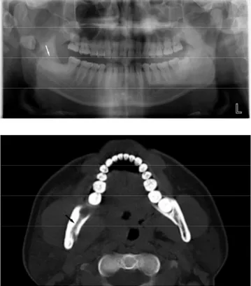 Fig.  1-A.  Pre-operative  panoramic  view  :  Panoramic  radiograph  showing  an  impacted  third  molar  associated  with  a  radiolucent  tunnel-like  appearance  (white  arrow)  in  the  right  subcondylar  region
