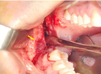 Fig.  2-B.  Extracted  mandibular  right  third  molar  (#48)  &amp;  cystic  wall  &amp;  fistula  tract.