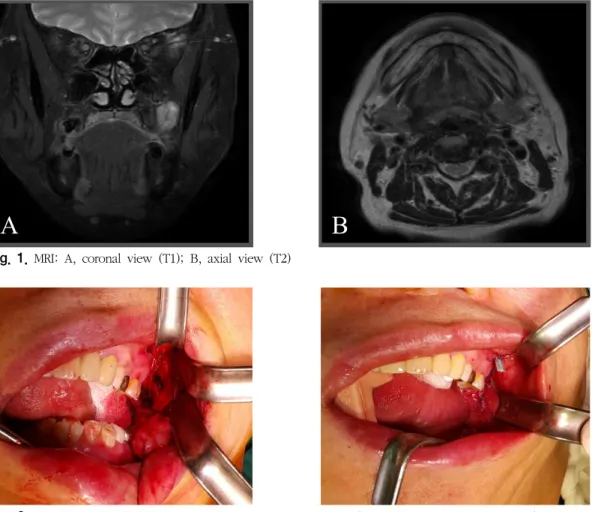 Fig.  1.  MRI:  A,  coronal  view  (T1);  B,  axial  view  (T2)