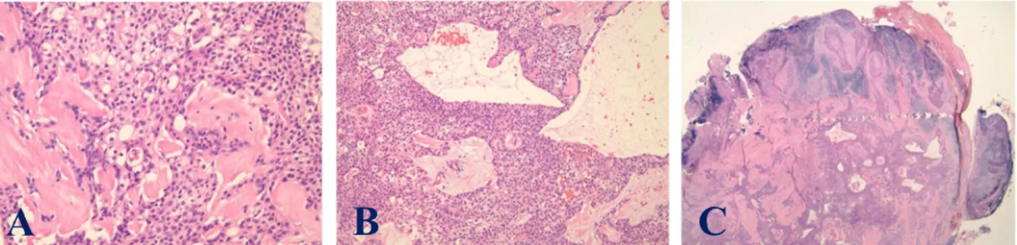 Fig.  4.  Hematoxylin  and  eosin  staining  Microscopic  examination  of  the  excised  mass